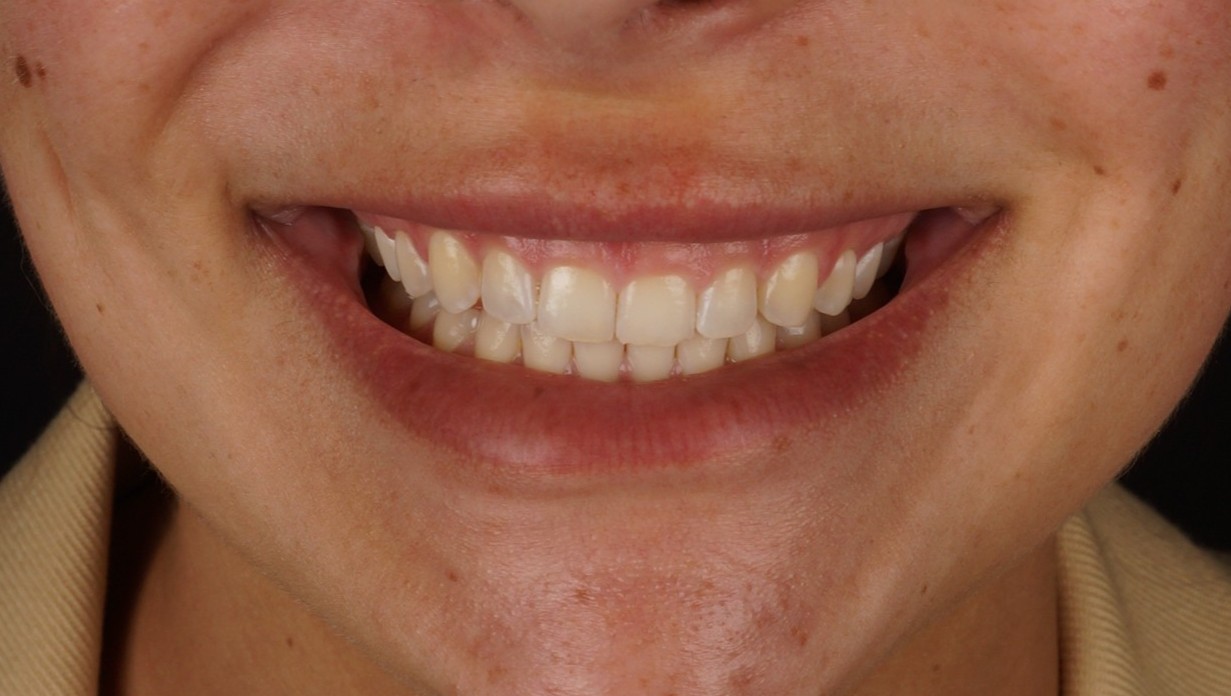 gum correction barcelona