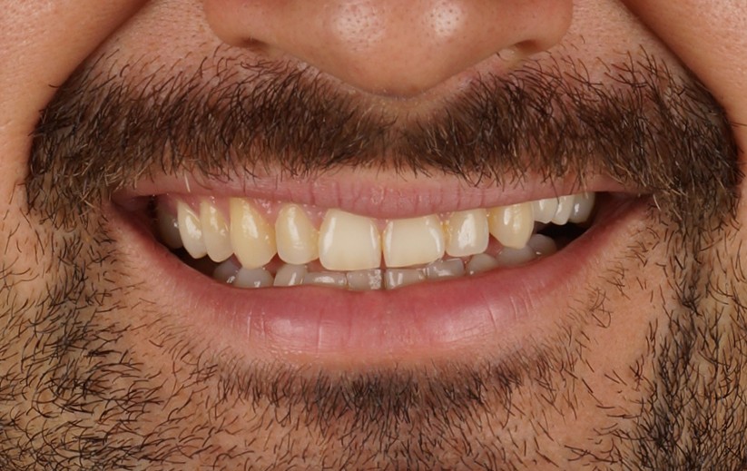 Mock up of 8 upper teeth with aesthetic resin - Before