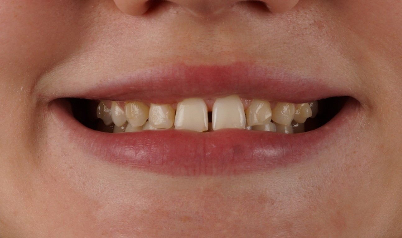 Philips Zoom Whitening + 10 composite veneers - Before