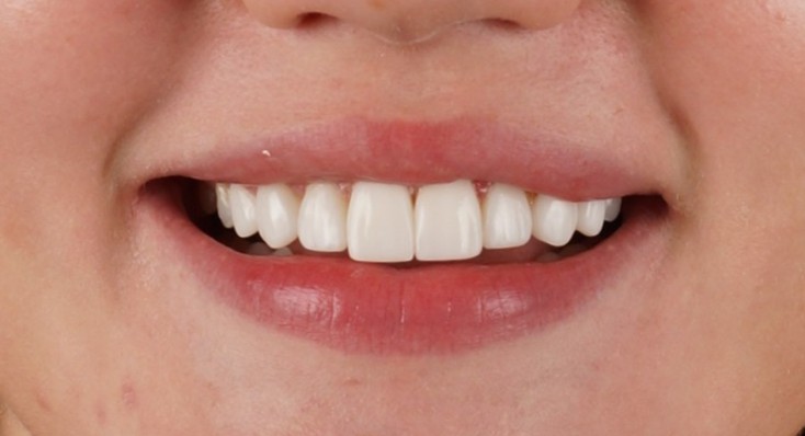 Philips Zoom Whitening + 10 composite veneers - After